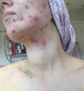 ACNE