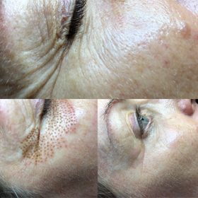 microneedling