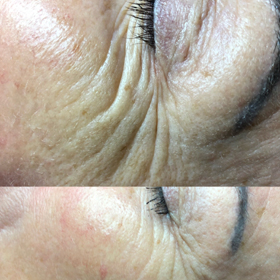 microneedling