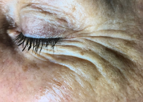 microneedling