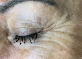microneedling