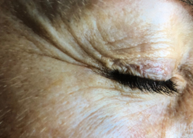 microneedling