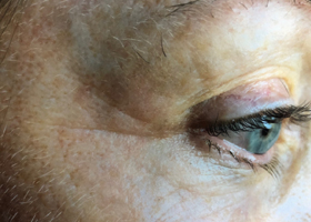 microneedling