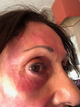 microneedling