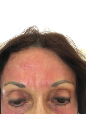 microneedling