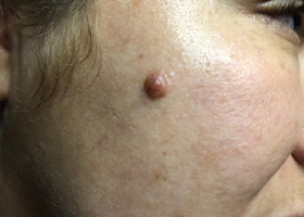 MOLE