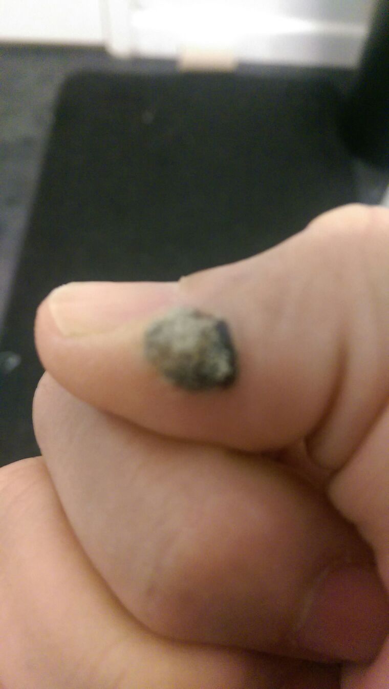 Wart Removal