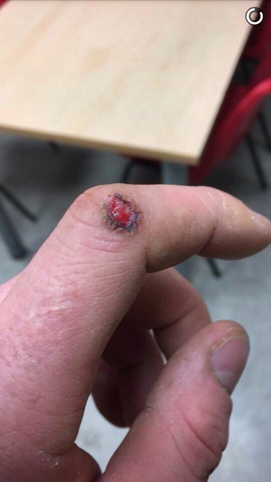 Wart Removal