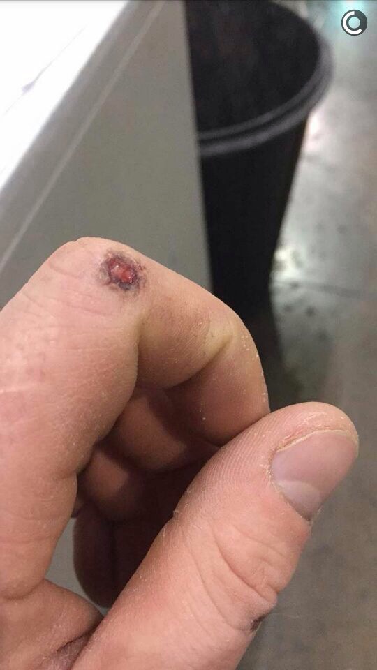 Wart Removal