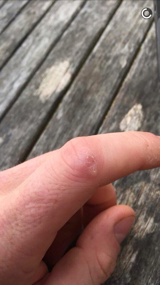 Wart Removal